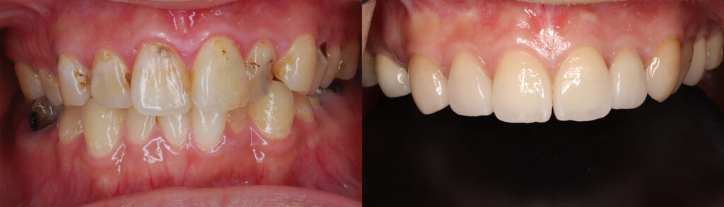 前歯のムシ歯の進行した治療前と修復後の審美的な歯面