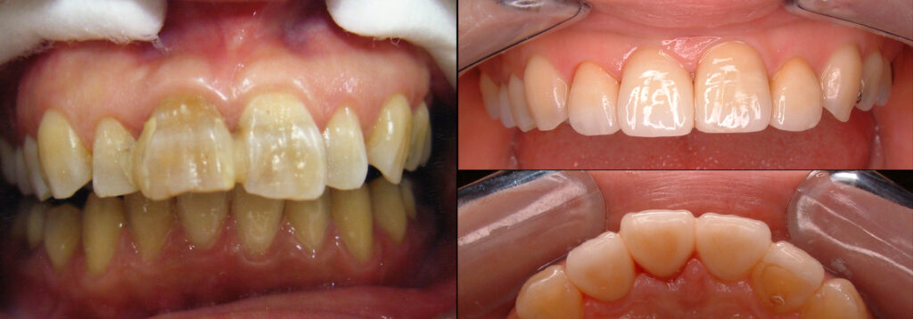 治療前の変色があり前突気味の4前歯と歯並びの揃った治療後