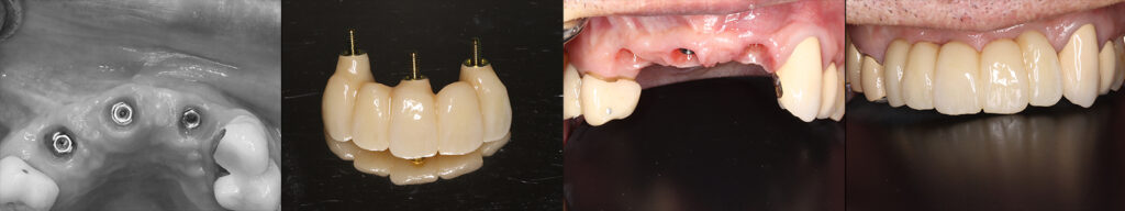 ５前歯のインプラント３本のブリッジによる再建