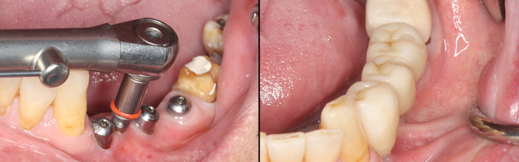 下顎臼歯暫間インプラントとインプラント修復