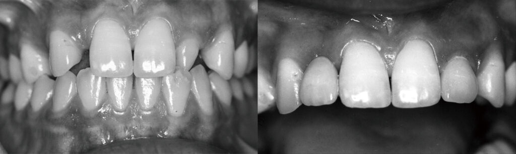先天欠損と側切歯と移動した犬歯および矯正後の修復完了時
