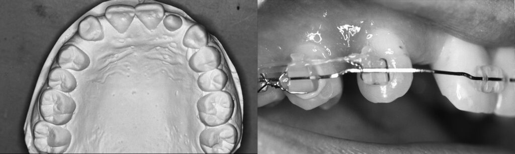 犬歯の矯正により側切歯のスペース確保