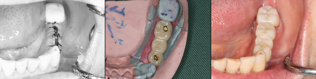 下顎臼歯部のインプラント維持のブリッジ模型と口腔内セット時
