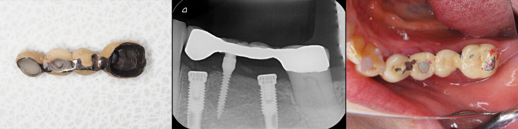 下顎臼歯部の既存ブリッジと暫間インプラント