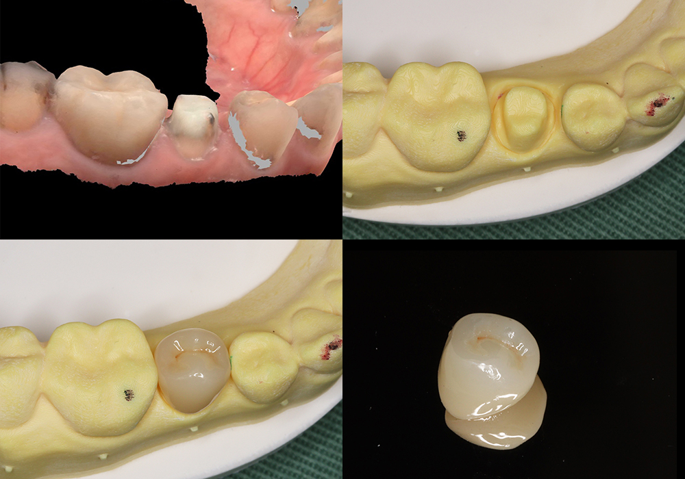 光学印象データと3Dプリンターによる模型とジルコニア修復物