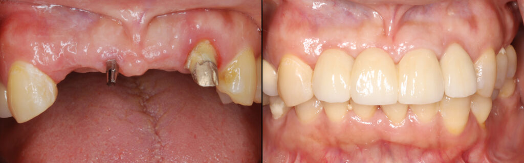 暫間インプラントと修復完了後