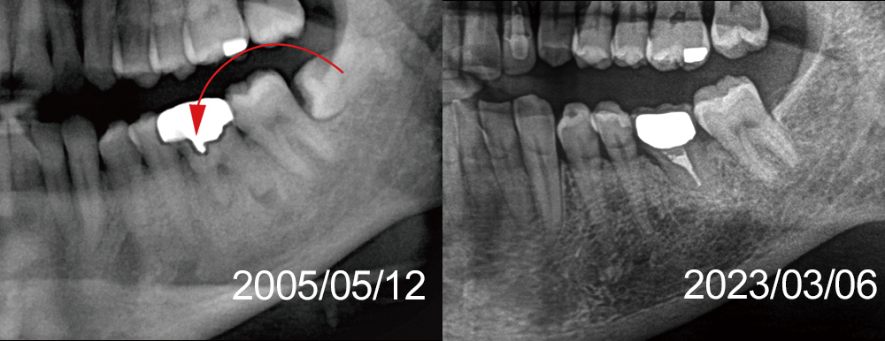 移植時2005年と2023年経過時のX線画像比較