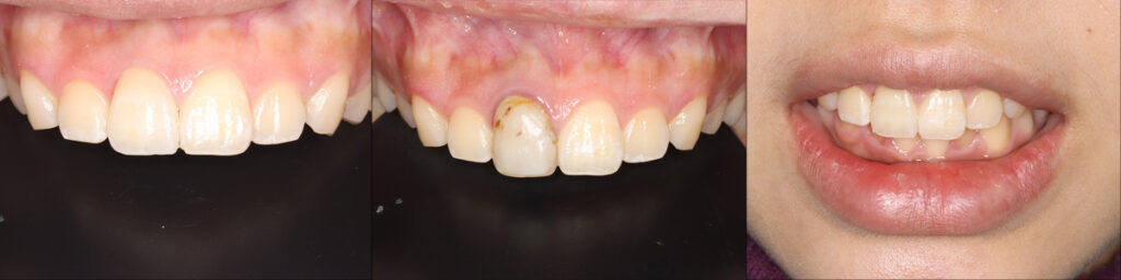 中切歯治療前後の比較画像