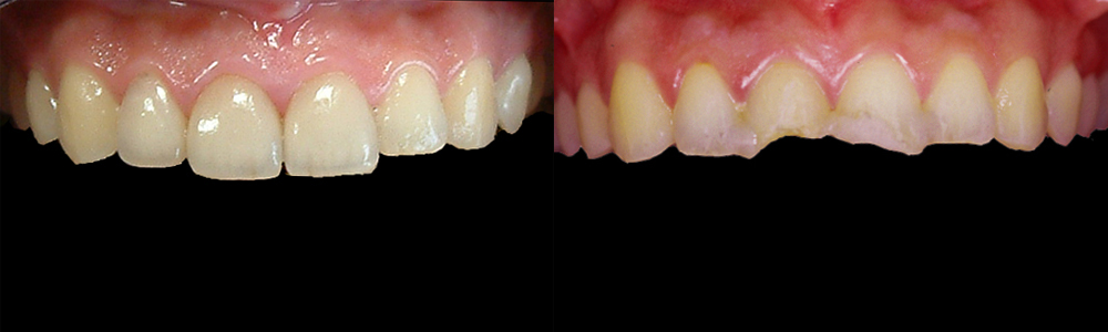 破折した３前歯と治療後