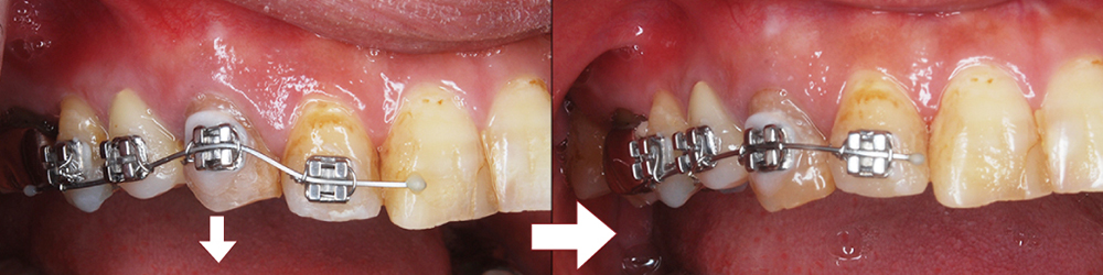 根管治療治癒不全の犬歯を挺出矯正