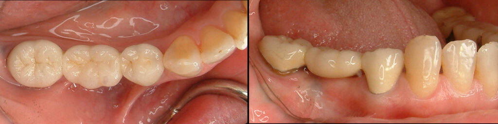 移植歯を利用したメタルボンドブリッジ３０年後