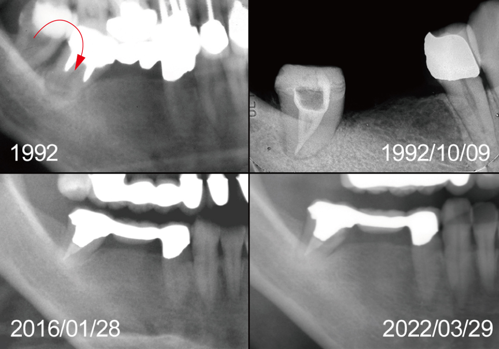 智歯移植前後３０年のX線画像