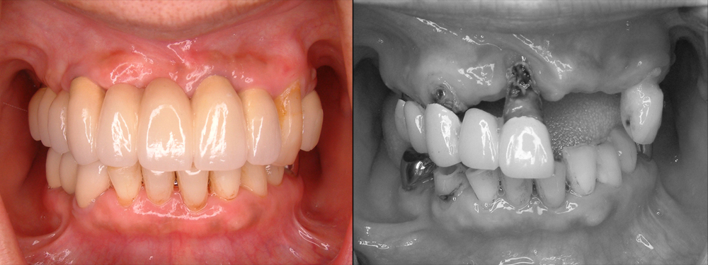 犬歯１歯を残して保存不能の上顎治療前とインプラント修復後