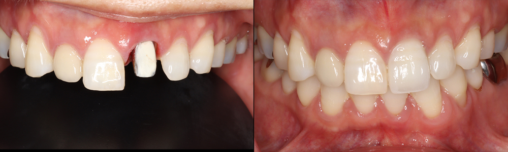 オペークレジンを接着したメタルコアと審美的歯冠修復