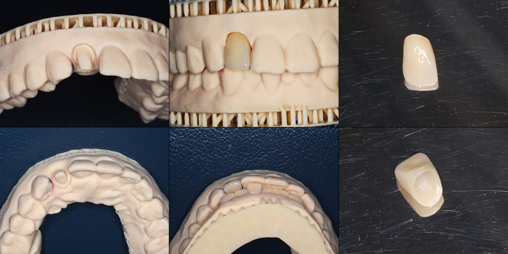 3Dプリンターによる作業模型と修復物