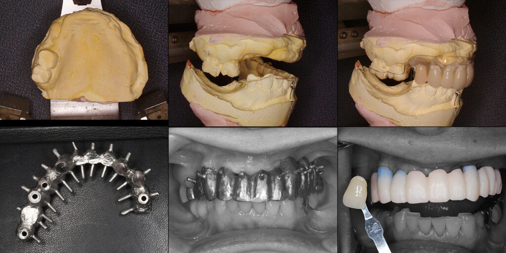 印象後の作業模型と金属フレームおよび試適用アクリル歯