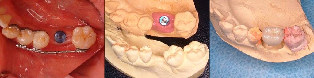 スペース確保後インプラント修復