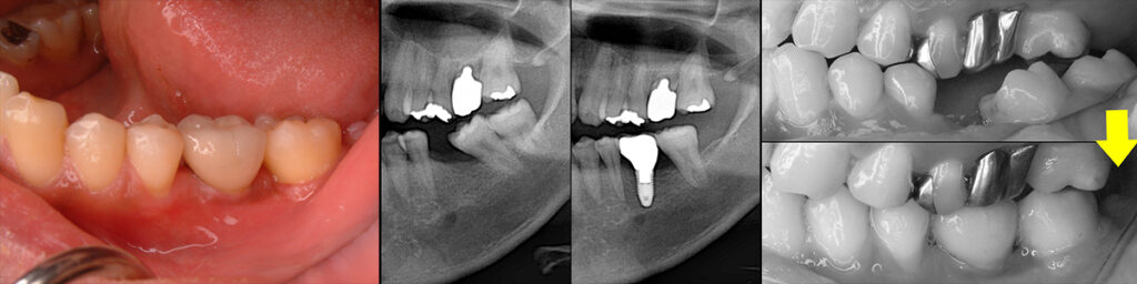 欠損部矯正とインプラント修復術前術後