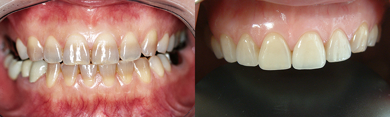 6前歯のラミネートベニア修復のビフォーアフター