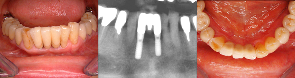 下顎前歯のインプラントブリッジ