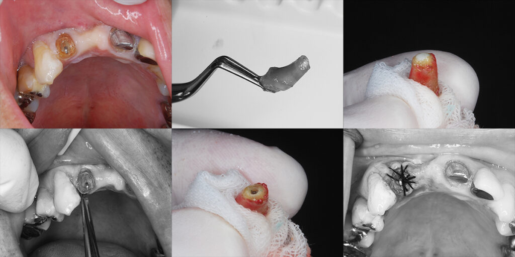 抜歯および根尖部の精査と封鎖後に再植