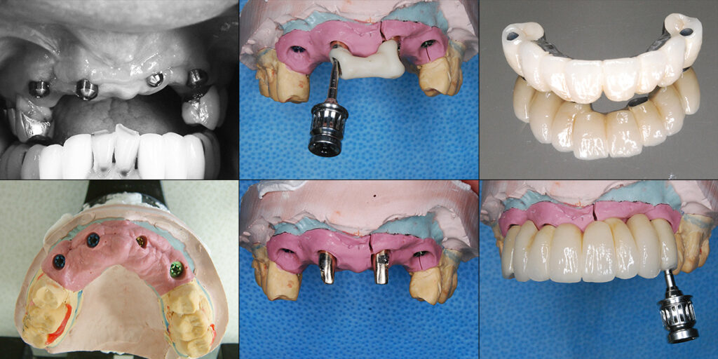 植立されたインプラントから模型と修復物の作製（内冠とスクリュー固定）