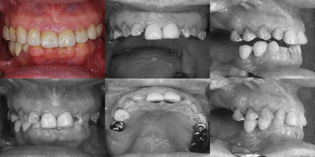 臼歯の咬みあわせが減り前歯が摩耗した口腔内