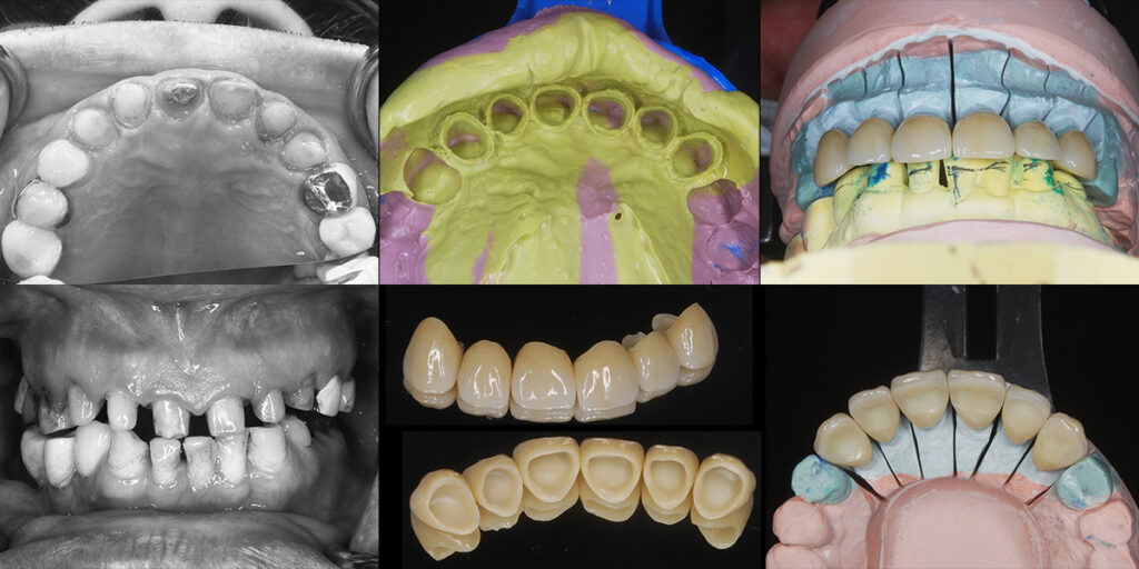6前歯の形成完了時の印象と模型、完成修復物