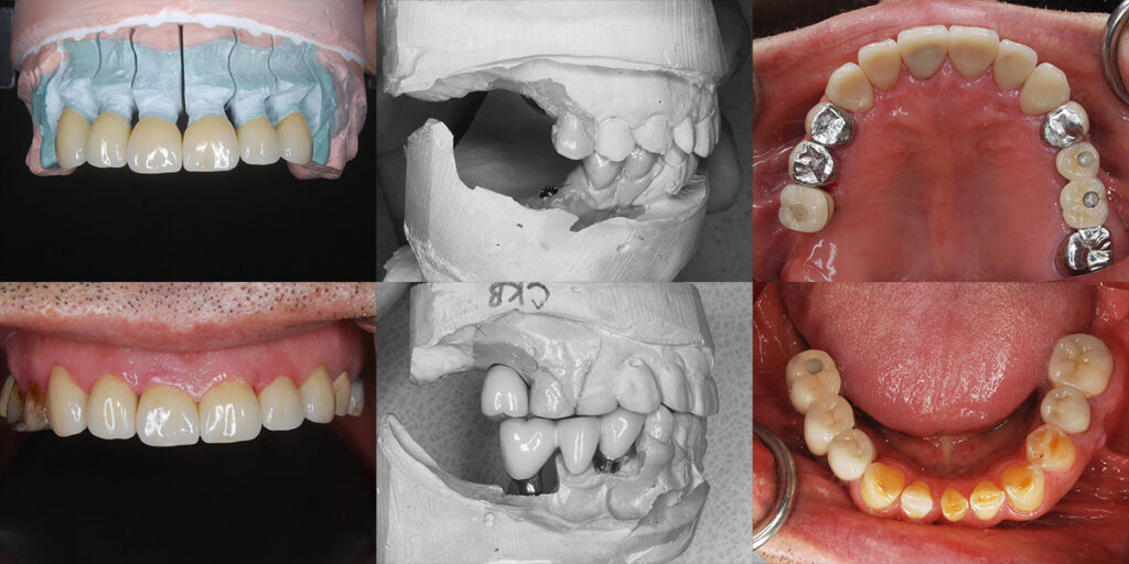 ６前歯ジルコニア冠の装着と臼歯部の咬合回復