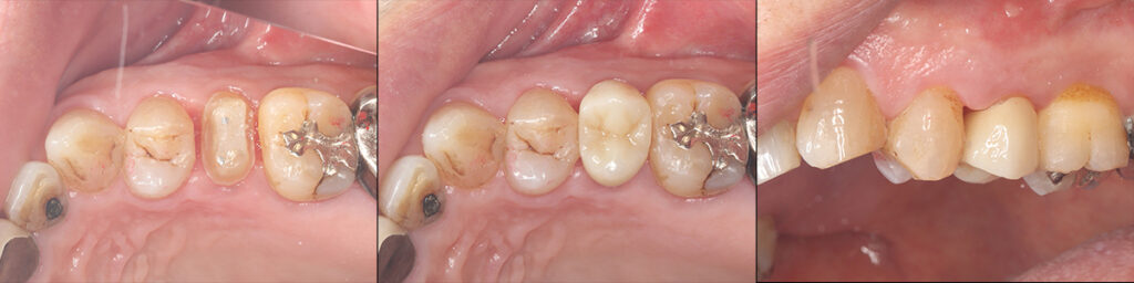 デジタルワークフローを経て口腔内にセット後