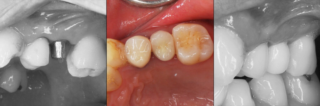 移植歯の安定後の歯冠修復