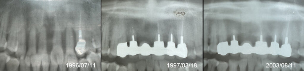 治療前のX線画像と治療後１６年のX線画像