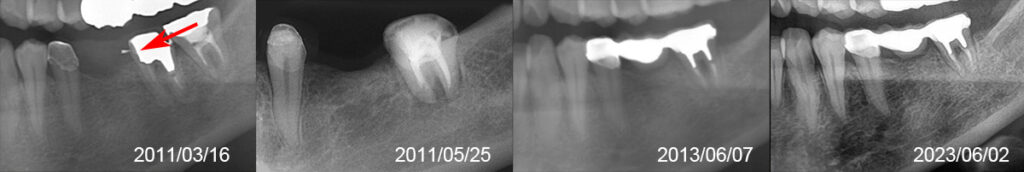 大臼歯移植とブリッジのX線画像１２年経過
