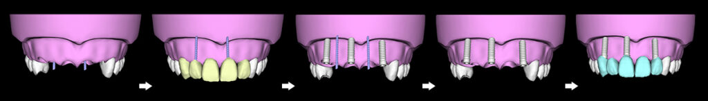 ５前歯欠損の暫間インプラントとインプラントブリッジの治療手順図