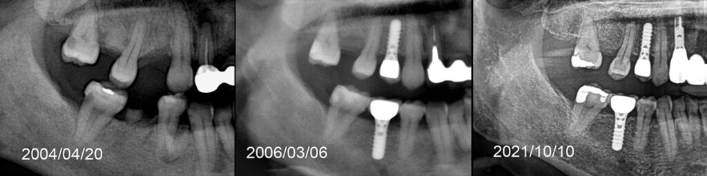 2004年治療開始時と2021年の経過X線画像比較