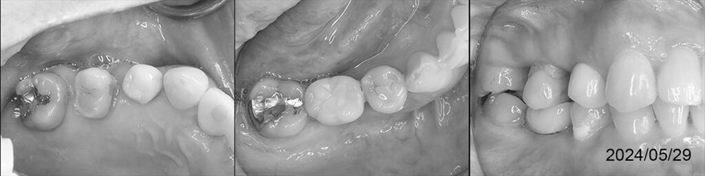 2024年６月時の口腔内の状態 治療開始から２０年後