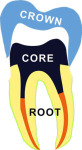 歯根・コア・クラウンのイラスト