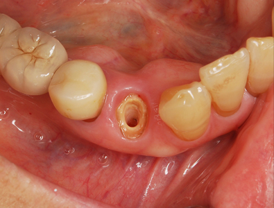 下顎小臼歯ポスト形成時