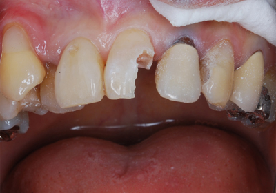 歯冠実質欠損大きな中切歯
