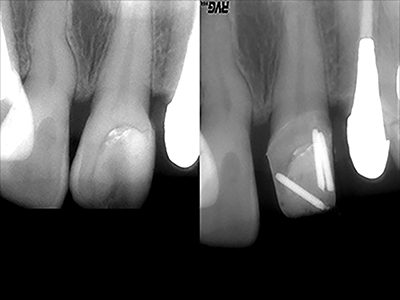 前歯部のピン築造の術前術後X線画像