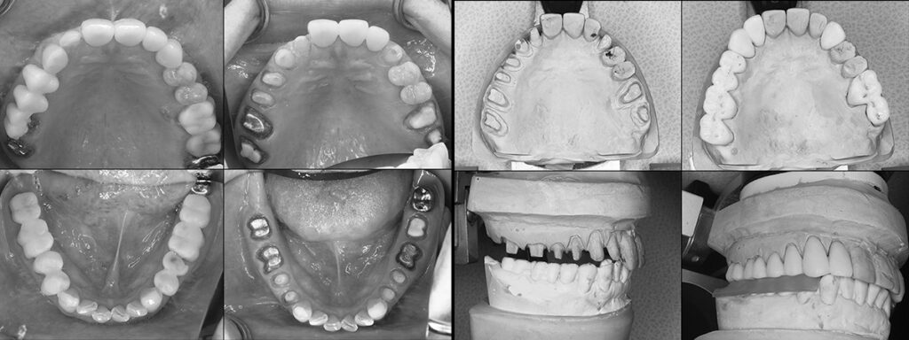 術前の仮歯と形成後、作業模型、模型上のジルコニア冠