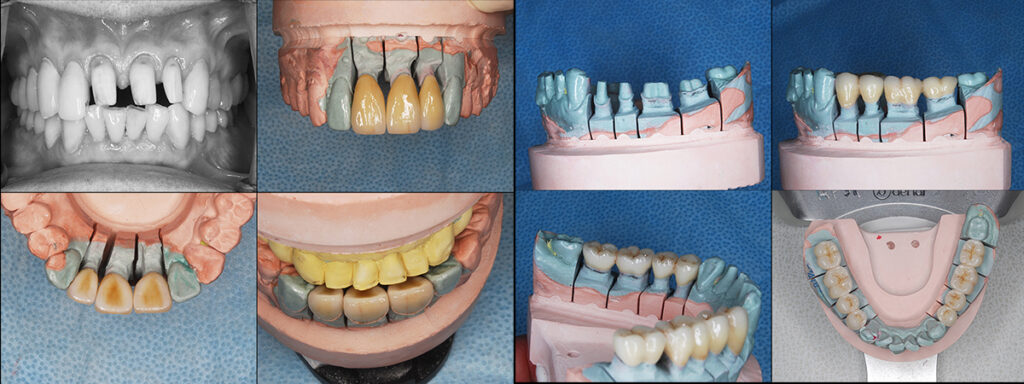 上顎前歯の修復と作業模型上でのクラウン