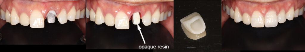 オペークレジンを表面に接着した前歯のメタルコア