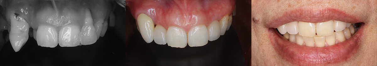 部分矯正とインプラントによる前歯部の再建